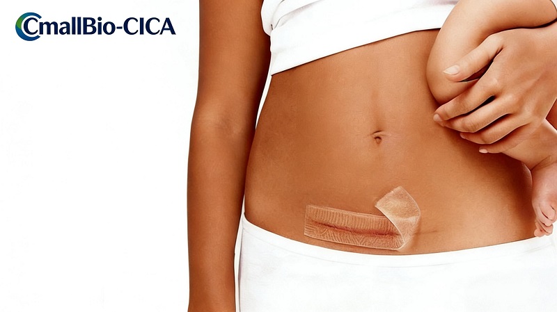 CmallBio Thickened Silicone Scar Patch (CmallBio-CICA) præsterer strålende for nylig og stabiliserer sin position i det øverste niveau inden for medicinsk silikonearfjernelse