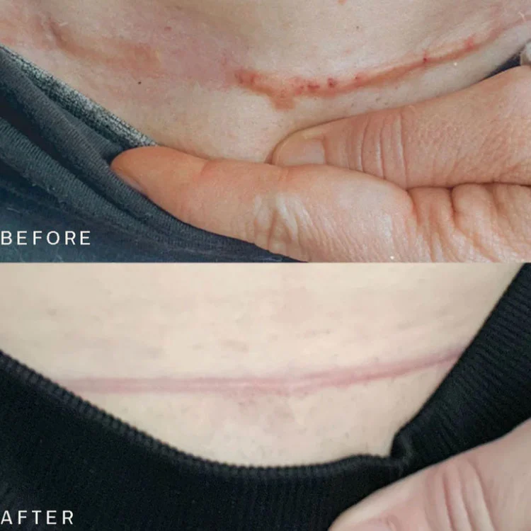 Waterproof Transparent Scar Patch For C Section